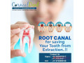 root-canal-treatment-in-hyderabad-small-0