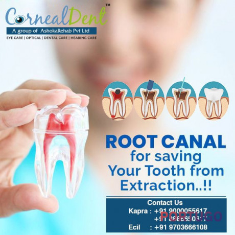 root-canal-treatment-in-hyderabad-big-0